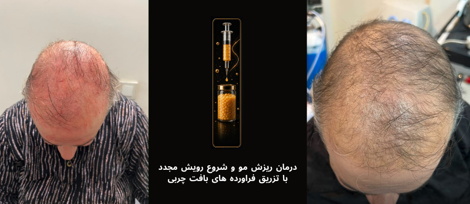 صفر تا صد تزریق چربی، SVF و نانو فت (دوره جدید)